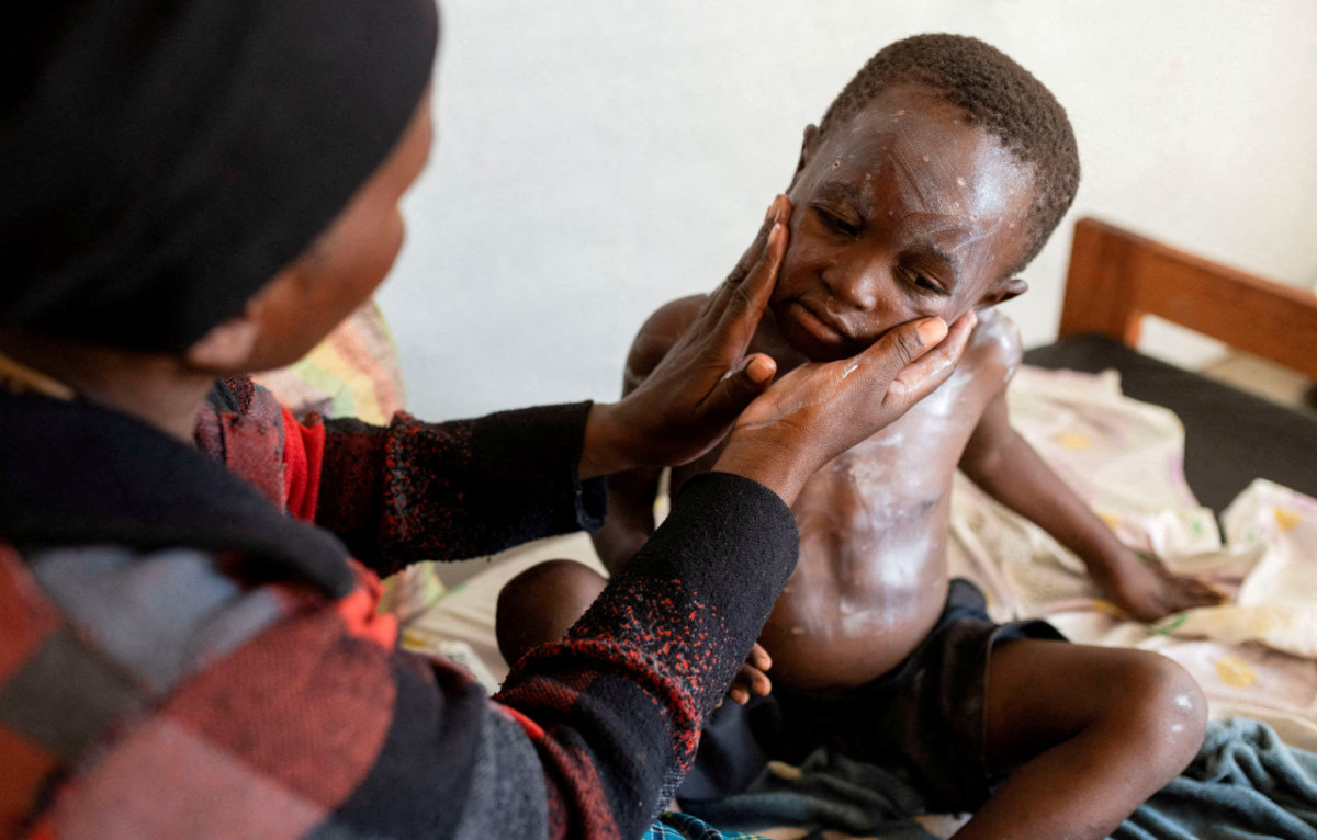 Mpox virus; viruela del mono. Foto: Reuters.